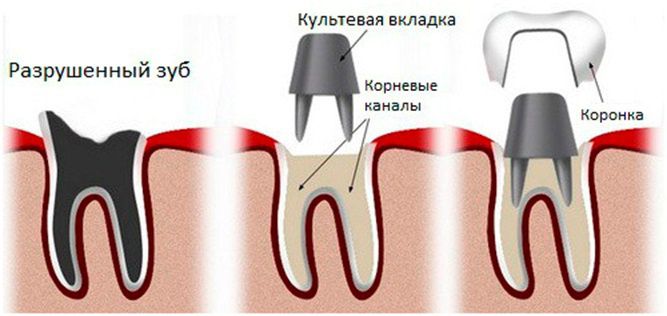 Непрямой метод реставрации зубов