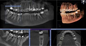 Протезирование на 6 имплантах при полном отсутствии зубов
