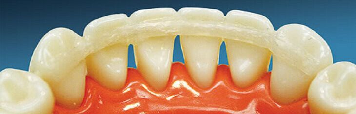 Сохранение зубов при пародонтите